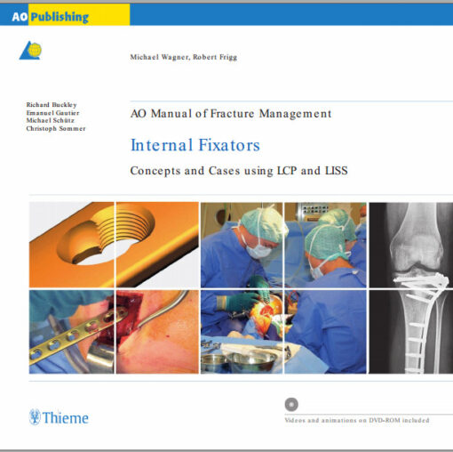 AO Manual of Fracture Management: Internal Fixators: Concepts and Cases using LCP/LISS