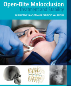 Ebook Open-Bite Malocclusion: Treatment and Stability 1st Edition