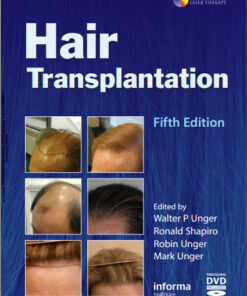 Ebook Hair Transplantation, Fifth Edition