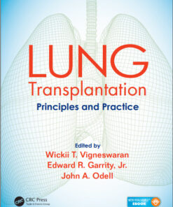 Lung Transplantation: Principles and Practice