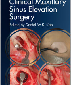 Ebook Clinical Maxillary Sinus Elevation Surgery 1st Edition