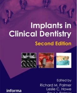 Implants in Clinical Dentistry, Second Edition