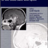 Chordomas and Chondrosarcomas of the Skull Base and Spine