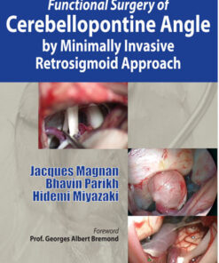 Functional Surgery of Cerebellopontine Angle by Minimally Invasive Retrosigmoid Approach