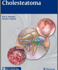 Cholesteatoma