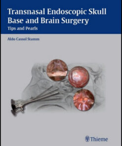 Transnasal Endoscopic Skull Base and Brain Surgery: Tips and Pearls