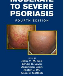 Moderate to Severe Psoriasis, Fourth Edition 4th Edition