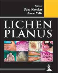 Lichen Planus