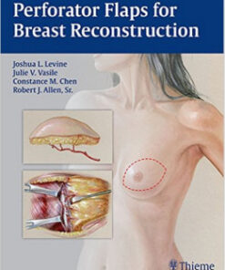 Perforator Flaps for Breast Reconstruction 1st Edition