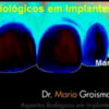 Aspectos Biologicos em Implantes Unitarios