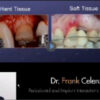 Implant Interactions in Orthodontics