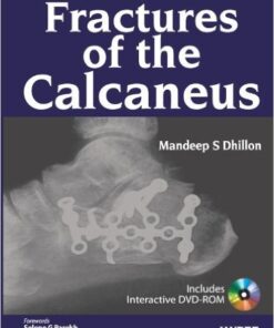 Fractures of the Calcaneus 1 Har/Dvdr Edition