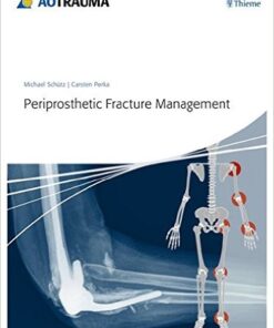 Periprosthetic Fracture Management 1st Edition