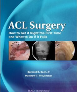 ACL Surgery: How To Get It Right the First Time and What To Do if it Fails 1st Edition