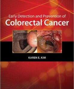 Early Detection and Prevention of Colorectal Cancer (Curbside Consultation) 1st Edition