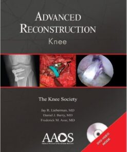 Advanced Reconstruction: Knee PDF