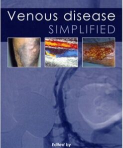 Venous Disease Simplified