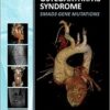 Aneurysms-Osteoarthritis Syndrome : SMAD3 Gene Mutations