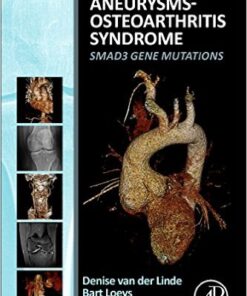 Aneurysms-Osteoarthritis Syndrome : SMAD3 Gene Mutations