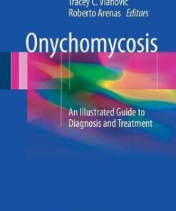 Onychomycosis: An Illustrated Guide to Diagnosis and Treatment 1st ed. 2017 Edition