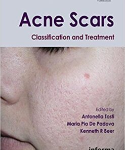 Acne Scars: Classification and Treatment (Series in Dermatological Treatment) 1st Edition PDF