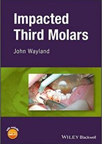 Impacted Third Molars PDF