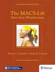 The MACS-Lift: Short-Scar Rhytidectomy 1st Edition PDF & video