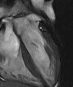 MRIOnline Mastery Series: Cardiac MRI of Non-Ischemic Cardiomyopathy 2021 (CME VIDEOS)