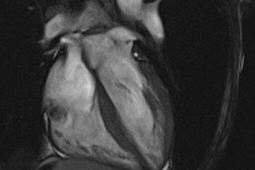 MRIOnline Mastery Series: Cardiac MRI of Non-Ischemic Cardiomyopathy 2021 (CME VIDEOS)