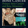 Bone Cancer Primary Bone Cancers and Bone Metastases