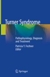 Turner Syndrome Pathophysiology, Diagnosis and Treatment 2020 ORIGINAL PDF