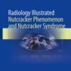 Radiology Illustrated: Nutcracker Phenomenon and Nutcracker Syndrome