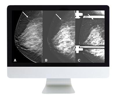 ARRS Breast Imaging: Screening and Diagnosis
