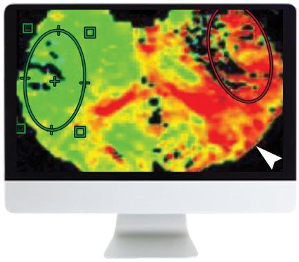 ARRS Code Stroke: What the Radiologist Needs to Know in the Changing Landscape of Acute Ischemic Stroke 2019