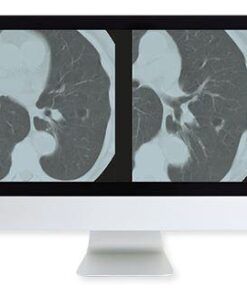 ARRS Lung Cancer Screening A Comprehensive Guide Online Course 2015