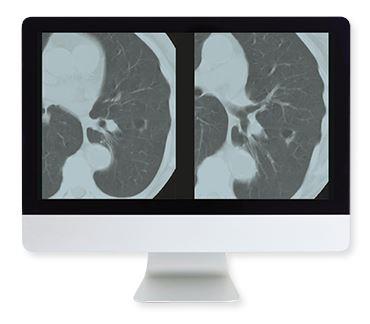 ARRS Lung Cancer Screening A Comprehensive Guide Online Course 2015