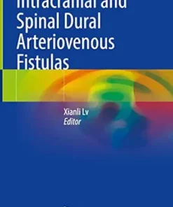 Intracranial and Spinal Dural Arteriovenous Fistulas (Original PDF from Publisher)