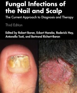 Fungal Infections of the Nail and Scalp: The Current Approach to Diagnosis and Therapy, 3rd Edition (Original PDF from Publisher)